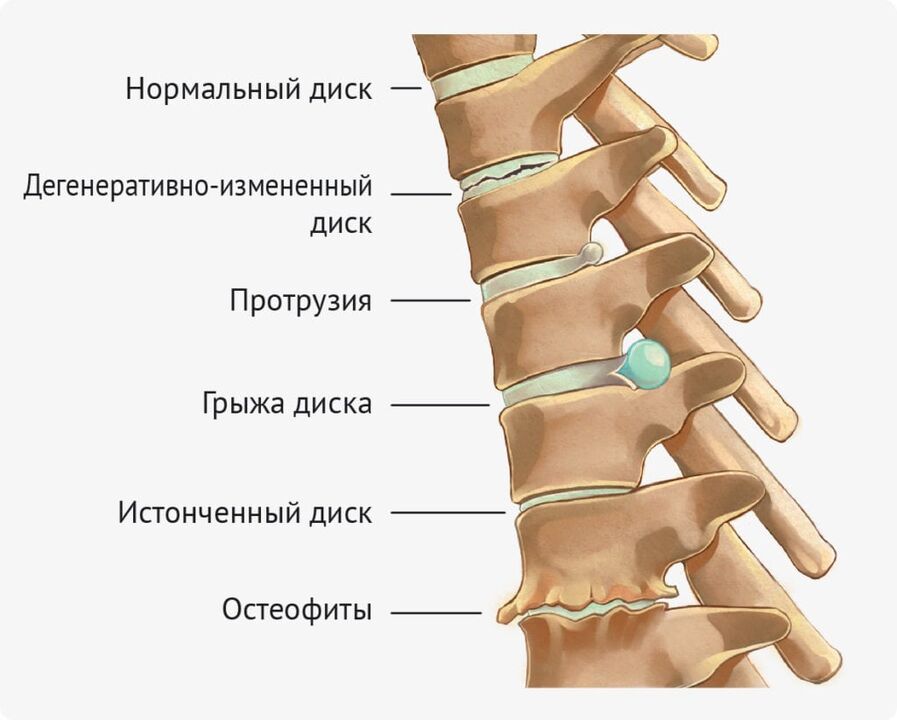 Deformità di sconto per l'osteocondosi lombare