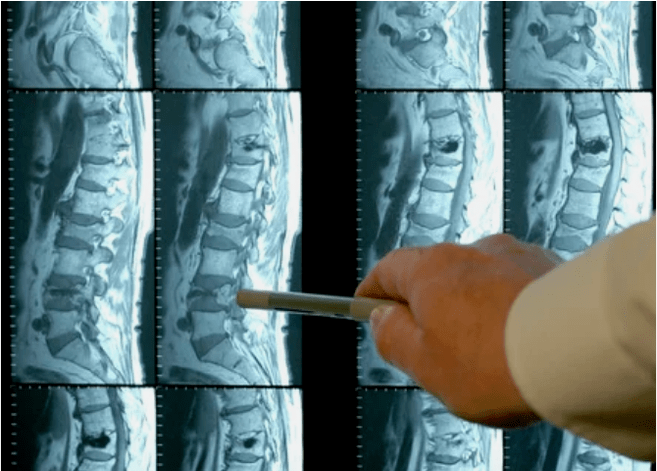 Varietà di osteocondrosi nella colonna vertebrale