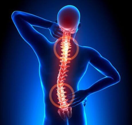 Osteocondrosi della colonna vertebrale