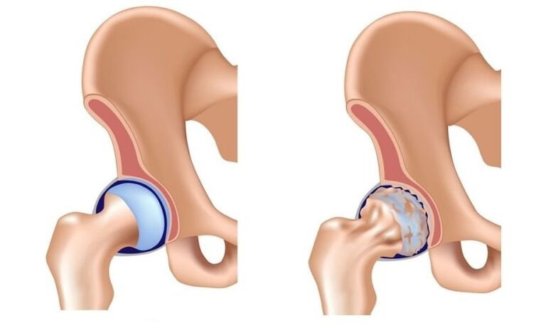 Articolazione e articolazione sane con osteoartrosi
