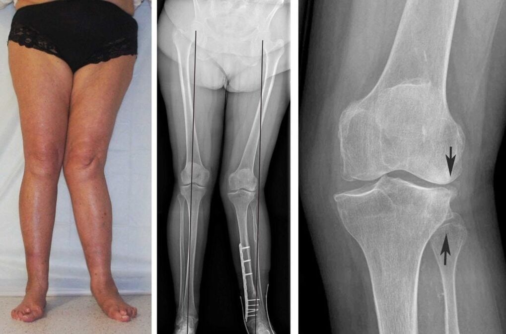 L'artrosi avanzata delle articolazioni del ginocchio può essere chiaramente vista visivamente anche senza una radiografia