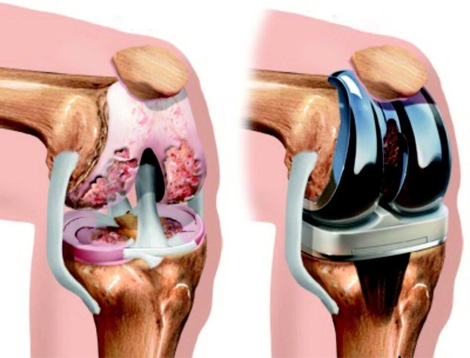 Se l'articolazione del ginocchio è completamente danneggiata dall'artrosi, può essere ripristinata utilizzando l'endoprotesi