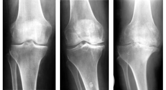 Una misura diagnostica obbligatoria per determinare l'artrosi del ginocchio è una radiografia